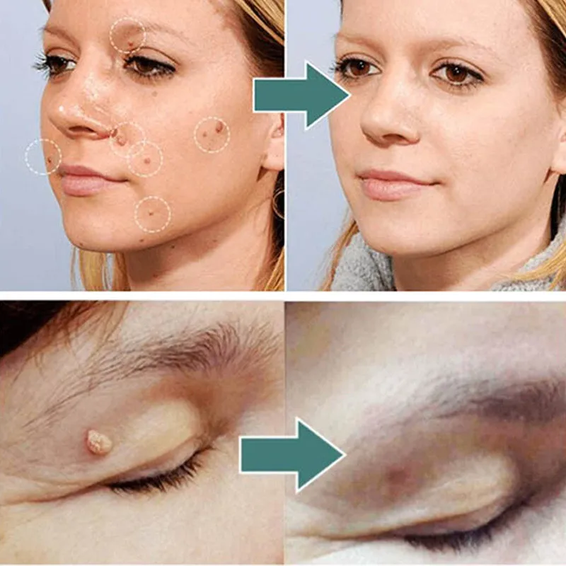 Lëkurë Të Re Tag Hequr Vaj Esencial Pa Dhimbje Lythat Nishan Lëkurë Të Errët Vend Mbartës Serum Freckle Fytyrën Wart Tag Trajtim Bukurie Shëndetësor . ' - ' . 1