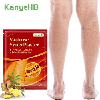 6Pcs=1Bag Venat me variçe Patch Lehtësimin e Këmbë Vasculitis Phlebitis Angiitis Spider Venë Dhimbje Bimor Mjekësor Gëlqere Kujdes Trupi W006